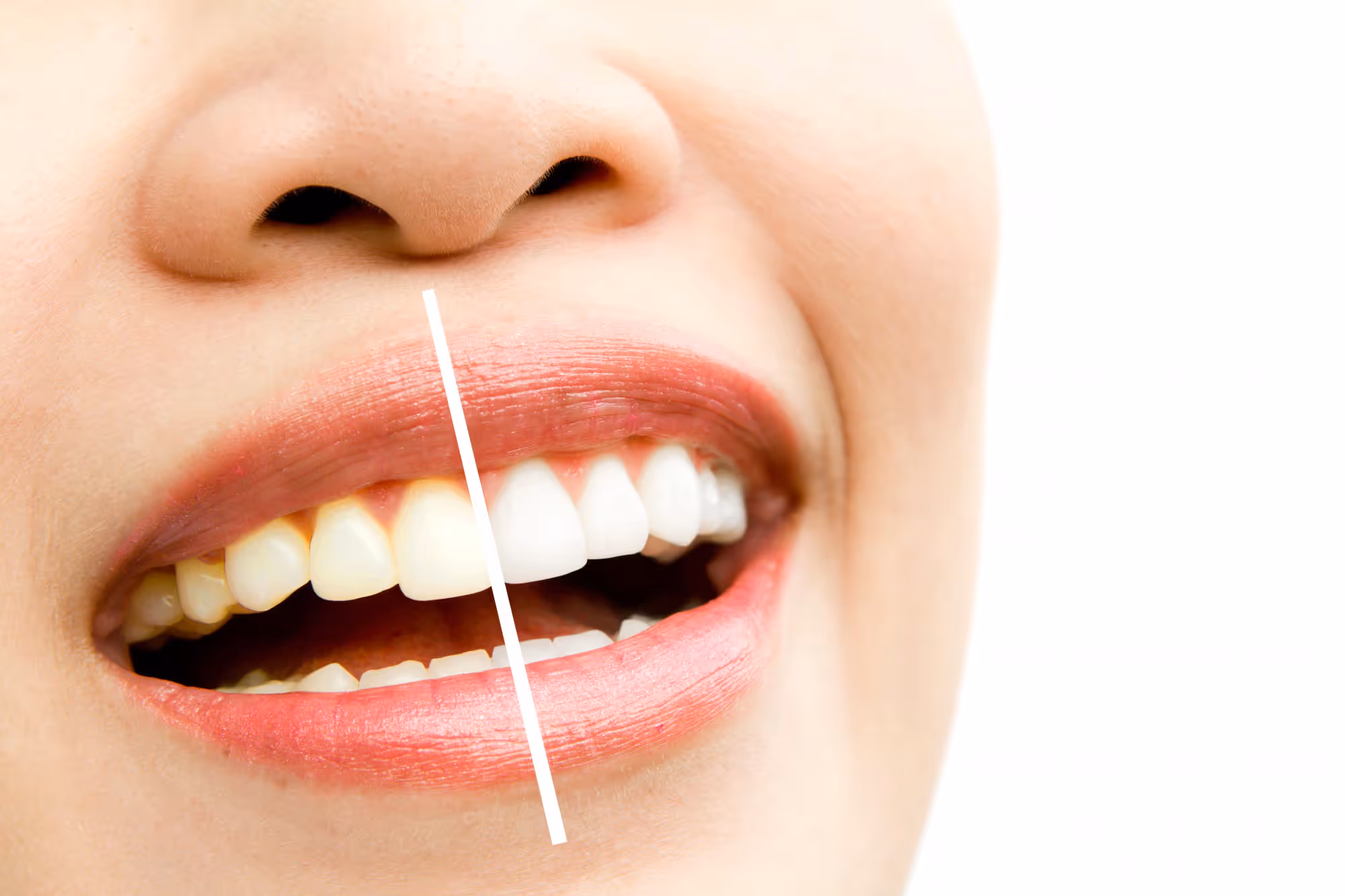 Teeth whitening